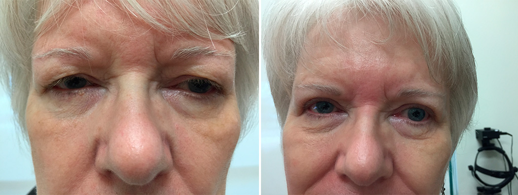 Before And Afters Miami Cataract Surgery 